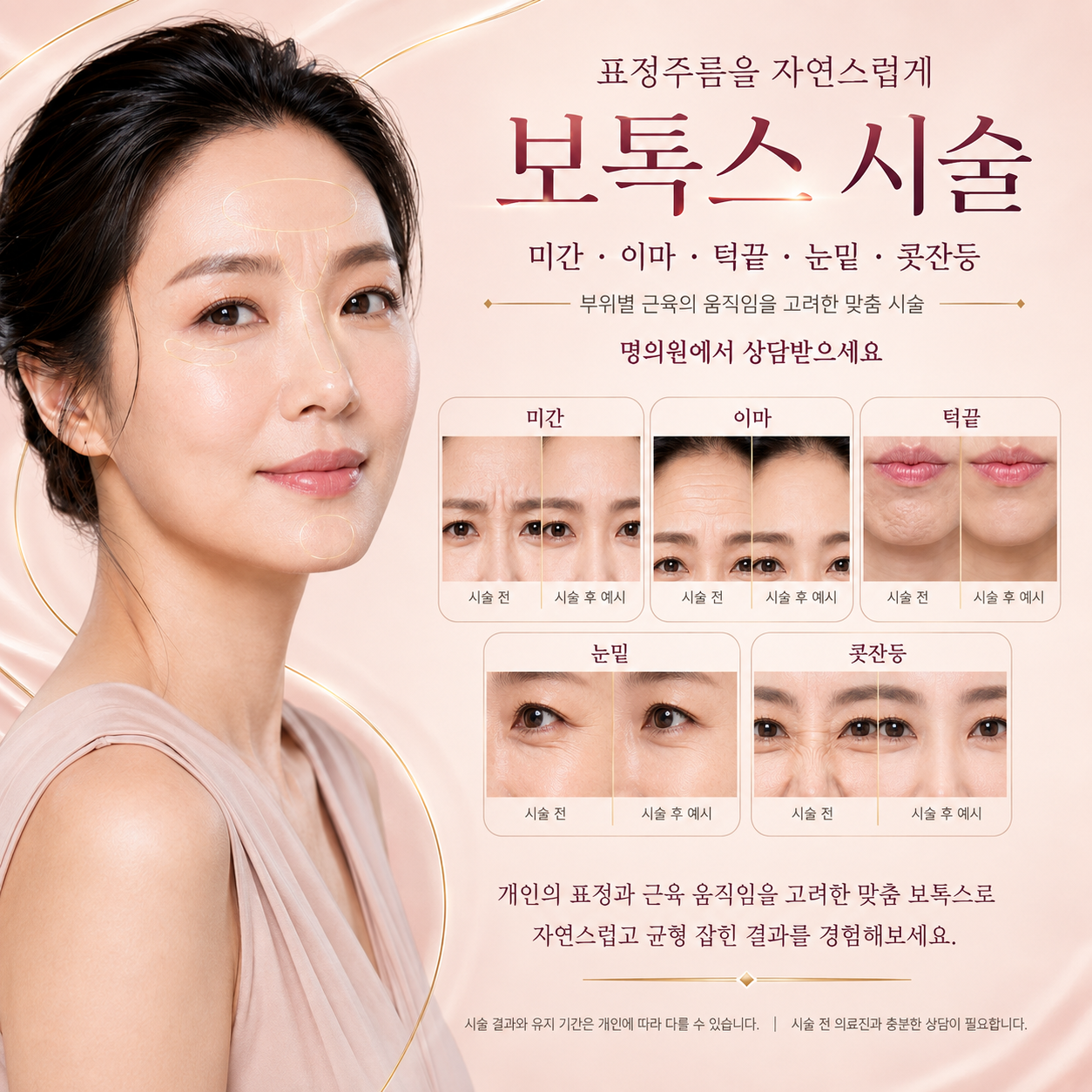보톡스 시술을 안내하는 제공 그래픽