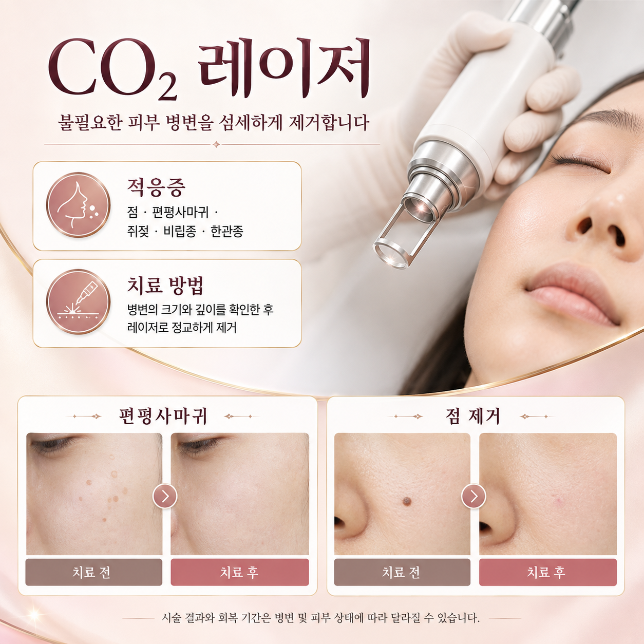 CO₂ 레이저 시술을 안내하는 제공 그래픽