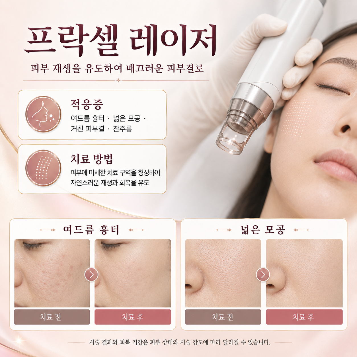 프락셀 레이저 시술을 안내하는 제공 그래픽