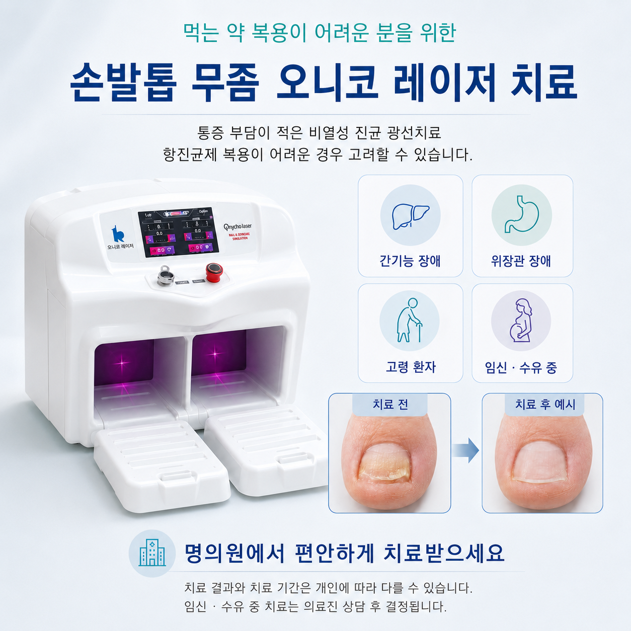 손발톱무좀 오니코 레이저치료를 안내하는 제공 그래픽