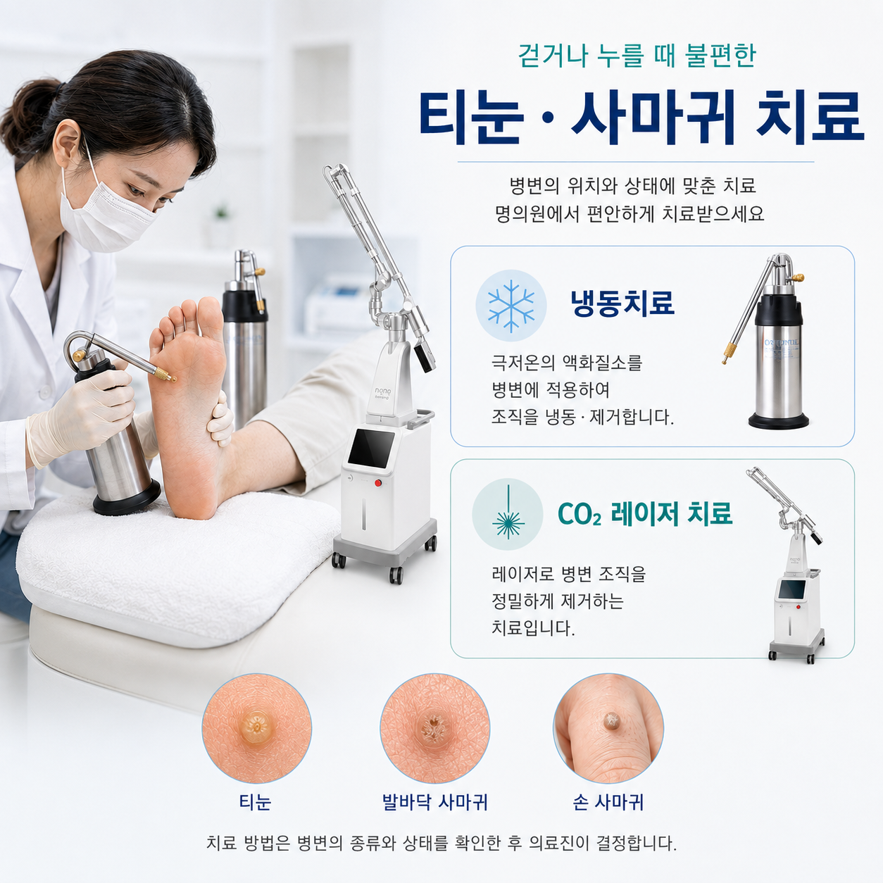 티눈·사마귀 치료를 안내하는 제공 그래픽