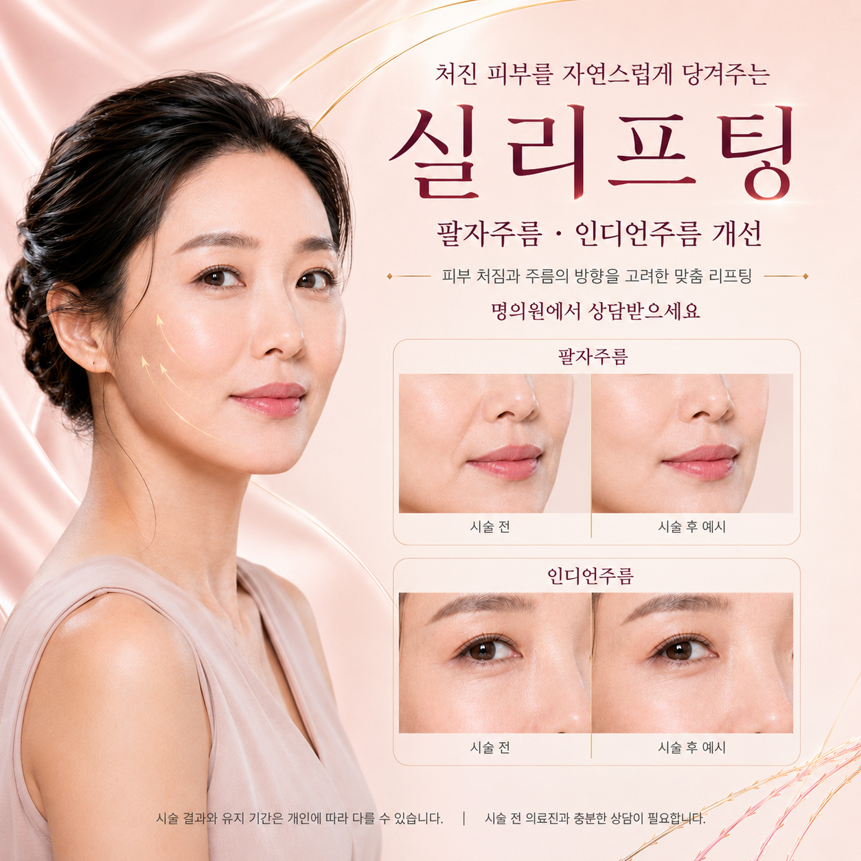 실리프팅 시술을 안내하는 제공 그래픽